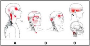 Techniques for Managing Neck Pain and Headaches - Arizona Orthopedic  Physical Therapy