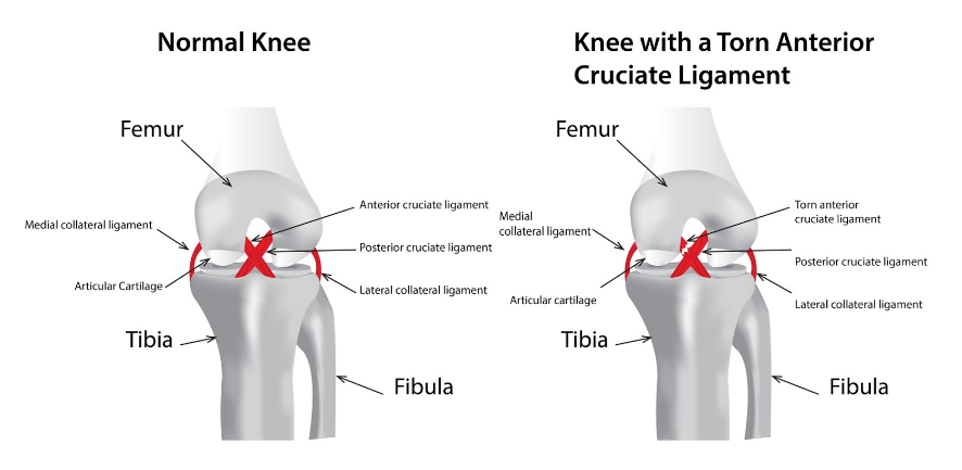 Guide  Physical Therapy Guide to Posterior Cruciate Ligament